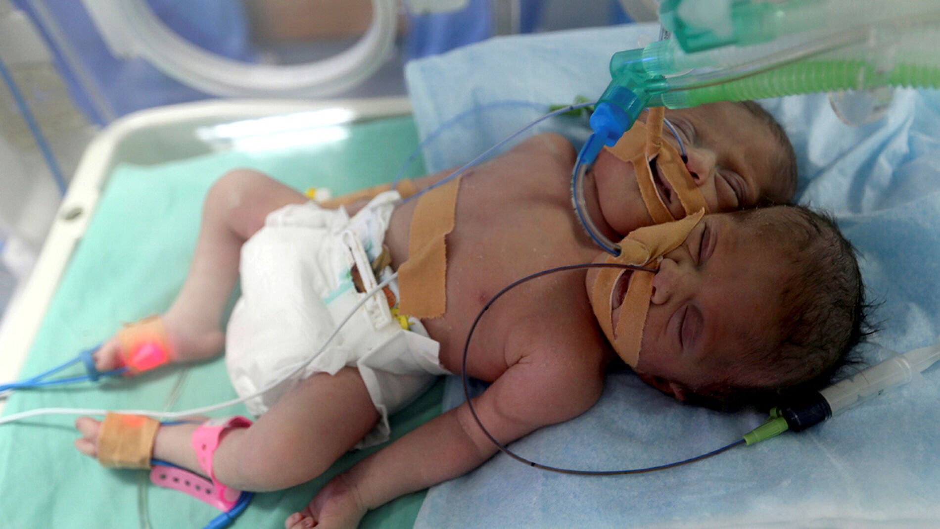 Las dos gemelas siamesas nacidas en Gaza