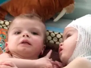 Recuperación bebés siameses Recuperación bebés siameses