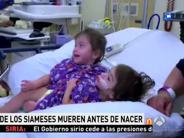 Eva y Erika, unas siamesas de California, cumplen 2 años Eva y Erika, unas siamesas de California, cumplen 2 años