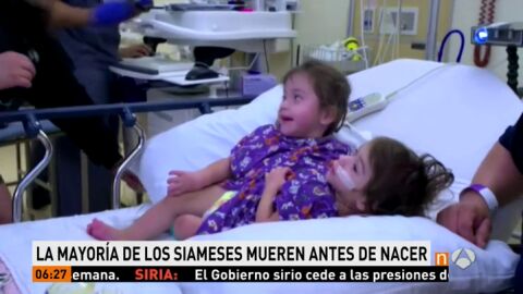 Eva y Erika, unas siamesas de California, cumplen 2 a&ntilde;os