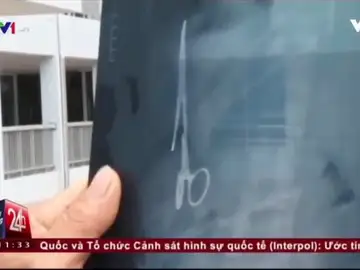 Frame 4.331555 de: Retiran unas tijeras olvidadas hace 18 años en el abdomen de un vietnamita durante una cirujía Frame 4.331555 de: Retiran unas tijeras olvidadas hace 18 años en el abdomen de un vietnamita durante una cirujía