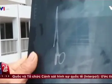 Frame 4.331555 de: Retiran unas tijeras olvidadas hace 18 años en el abdomen de un vietnamita durante una cirujía Frame 4.331555 de: Retiran unas tijeras olvidadas hace 18 años en el abdomen de un vietnamita durante una cirujía