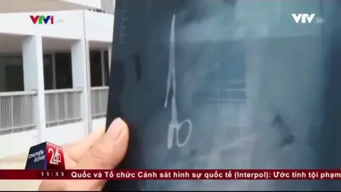 Frame 4.331555 de: Retiran unas tijeras olvidadas hace 18 años en el abdomen de un vietnamita durante una cirujía Frame 4.331555 de: Retiran unas tijeras olvidadas hace 18 años en el abdomen de un vietnamita durante una cirujía