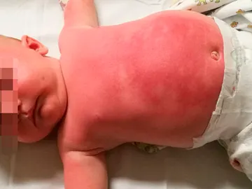 Bebé hospitalizado tras usar una crema protectora Bebé hospitalizado tras usar una crema protectora
