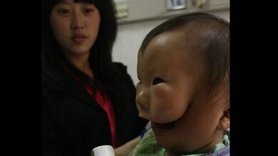 La dura historia del 'niño de la máscara', un niño que parece tener dos caras debido a una anomalía