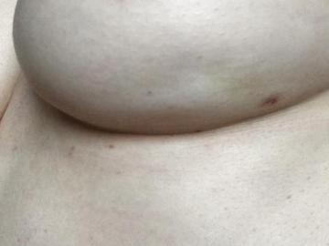 La foto del pecho izquierdo de Clara Warner presenta un hoyuelo, síntoma del cáncer de mama