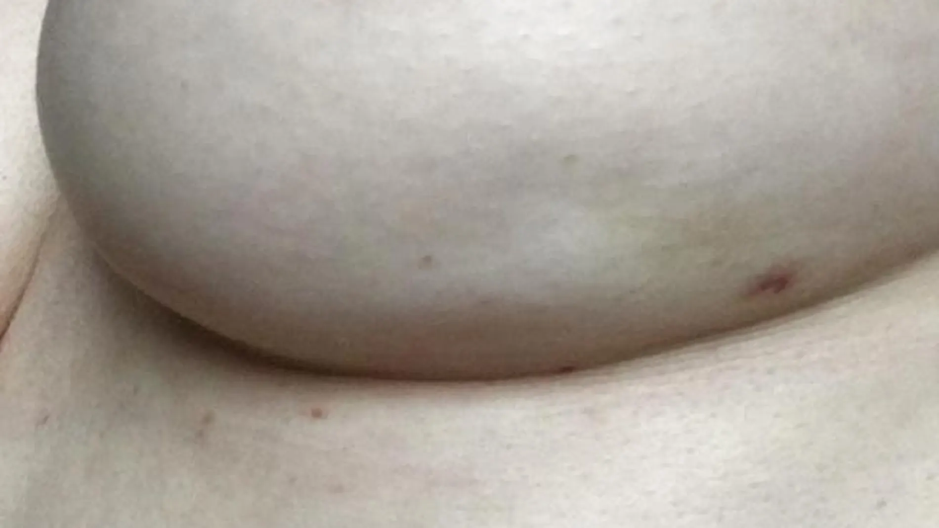 La foto del pecho izquierdo de Clara Warner presenta un hoyuelo, síntoma del cáncer de mama La foto del pecho izquierdo de Clara Warner presenta un hoyuelo, síntoma del cáncer de mama