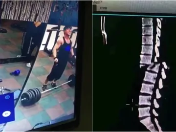 Imagen del momento en que se rompe la espalda Imagen del momento en que se rompe la espalda