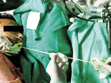 Momento de la extracción de la tenia Momento de la extracción de la tenia