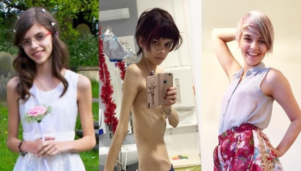 La evolución de la joven que sufría anorexia