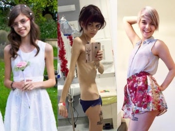 La evolución de la joven que sufría anorexia