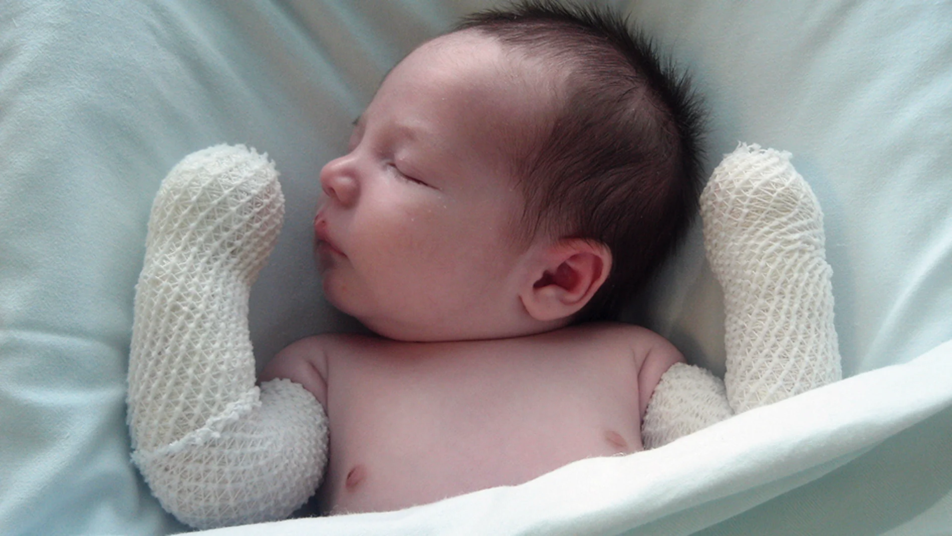 Bebé piel de mariposa Bebé piel de mariposa