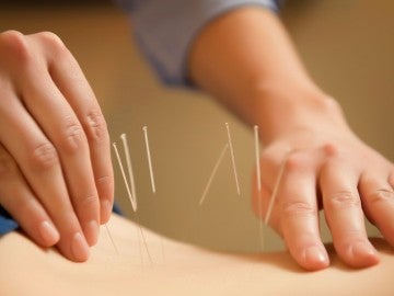 La acupuntura es un elemento clave en la medicina tradicional china. 