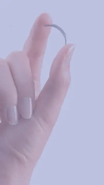 Essure es un pequeño muelle que se usa como anticonceptivo Essure es un pequeño muelle que se usa como anticonceptivo