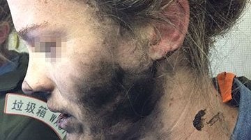 Mujer que sufrió quemaduras en la cara y cuello