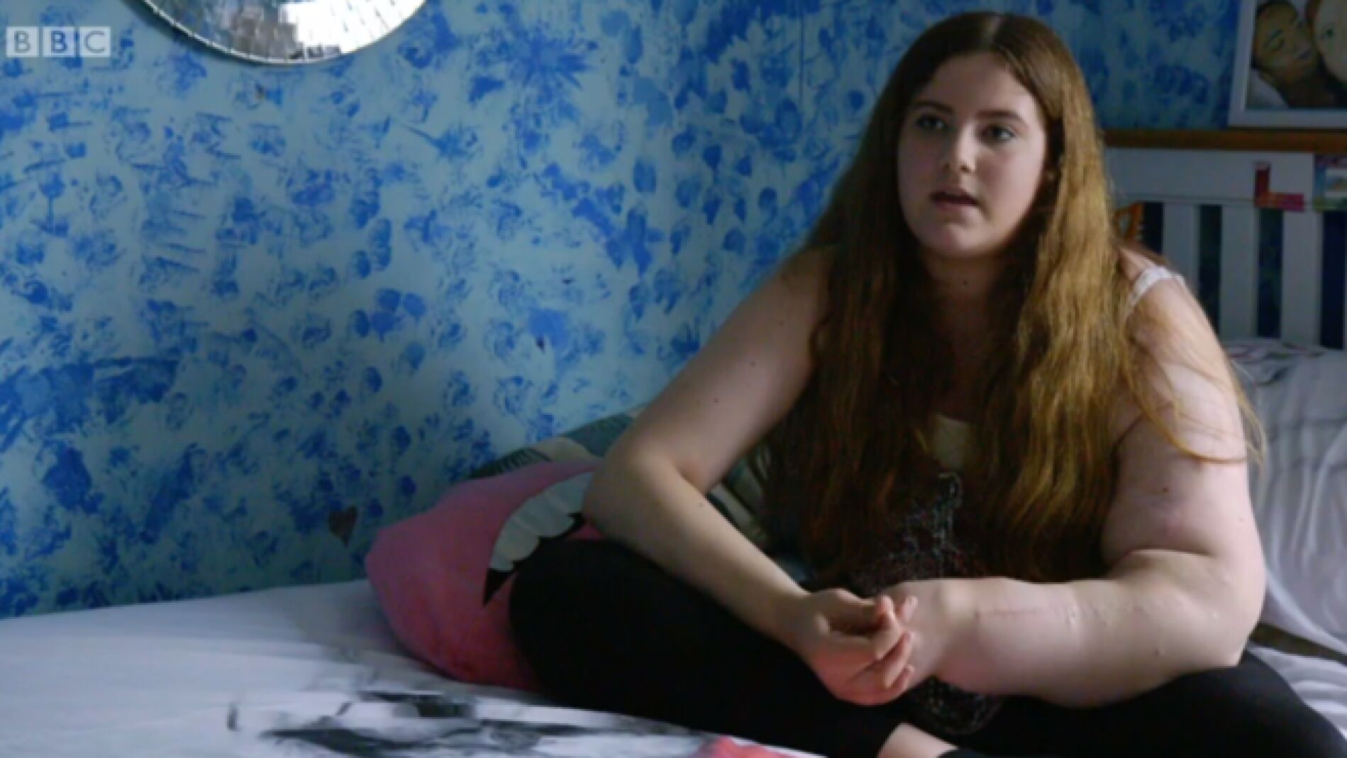 Leah Hardcastle la joven con 14 a&ntilde;os a la que no le para de crecer el brazo