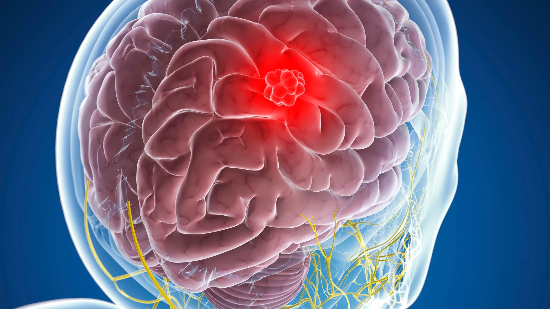 cáncer cerebral cáncer cerebral