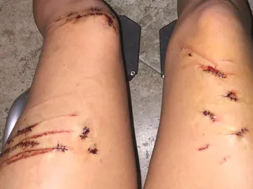 Una joven sobrevive al ataque de un tiburón tras propiciarle un puñetazo Una joven sobrevive al ataque de un tiburón tras propiciarle un puñetazo