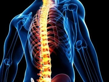 Un paralítico consigue andar debido a un implante de un dispositivo en la médula espinal