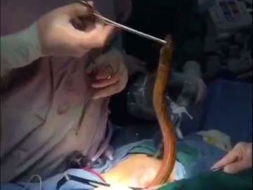 Una anguila siendo extraída durante la intervención quirúrgica