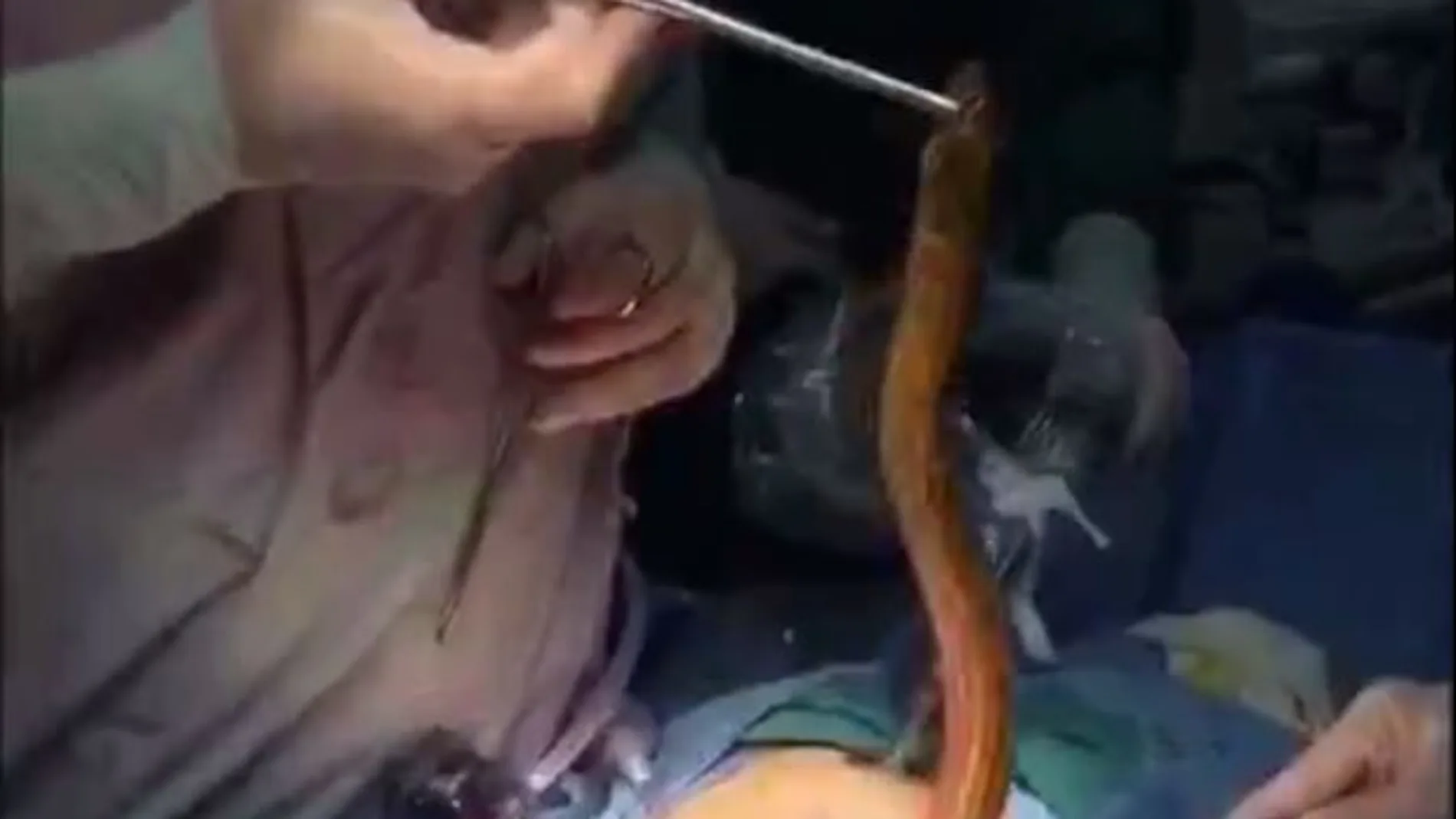 Una anguila siendo extraída durante la intervención quirúrgica Una anguila siendo extraída durante la intervención quirúrgica