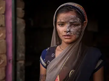 Khushboo Devi, rociada con ácido por su padre Khushboo Devi, rociada con ácido por su padre