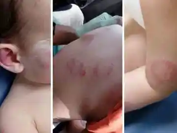 Mordiscos en el cuerpo del niño Mordiscos en el cuerpo del niño