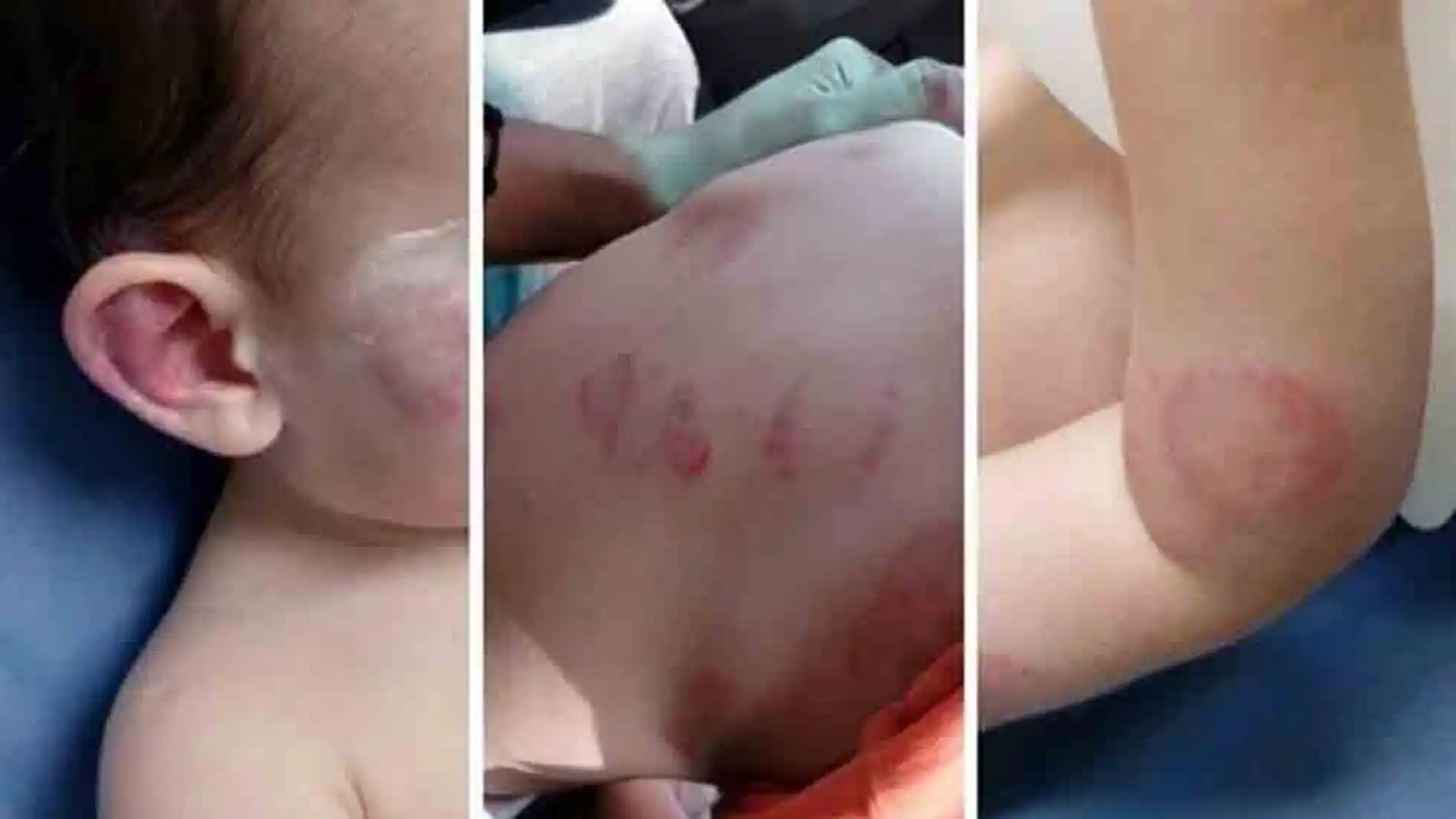 Mordiscos en el cuerpo del niño Mordiscos en el cuerpo del niño