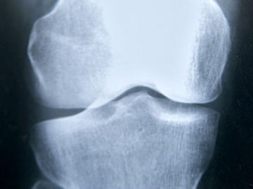 Una mutacion predispone a la fractura de femur en pacientes con osteoporosis