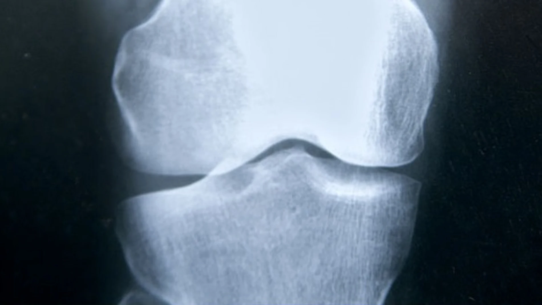Una mutacion predispone a la fractura de femur en pacientes con osteoporosis Una mutacion predispone a la fractura de femur en pacientes con osteoporosis