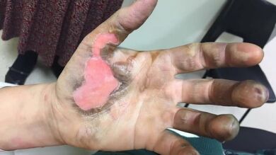  Una mujer sufre quemaduras de tercer grado después de que le explote su cigarrillo electrónico