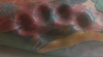 Podría perder el brazo tras implantarse un puño americano Podría perder el brazo tras implantarse un puño americano