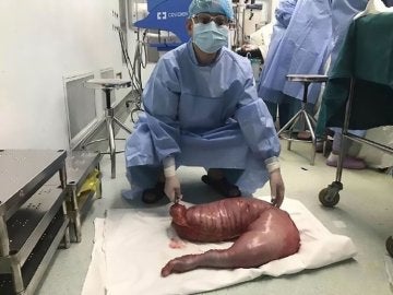 Un cirujano con el intestino de 13 kilos