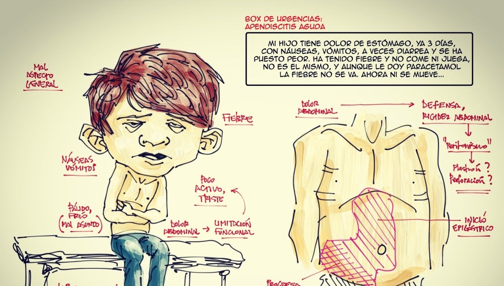 Dibujo para saber si tienes apendicitis