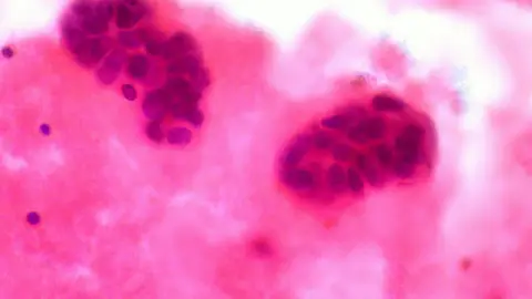 Metástasis Metástasis