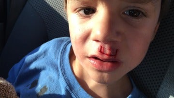 Un niño herido por un fidget spinner