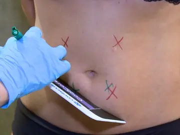 Llega una alternativa a la liposucción: congelar la grasa localizada a 11 grados bajo cero Llega una alternativa a la liposucción: congelar la grasa localizada a 11 grados bajo cero