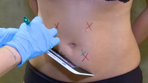 Llega una alternativa a la liposucción: congelar la grasa localizada a 11 grados bajo cero Llega una alternativa a la liposucción: congelar la grasa localizada a 11 grados bajo cero