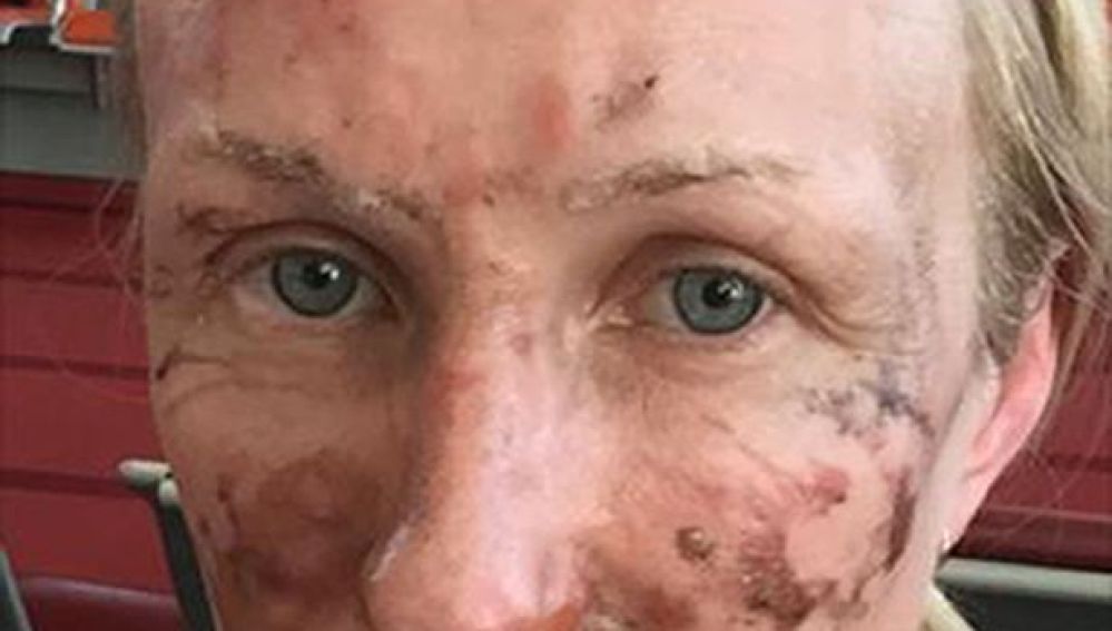 Una mujer sufre quemaduras en el rostro por un postre
