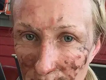Una mujer sufre quemaduras en el rostro por un postre Una mujer sufre quemaduras en el rostro por un postre