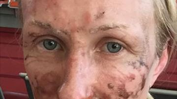 Una mujer sufre quemaduras en el rostro por un postre