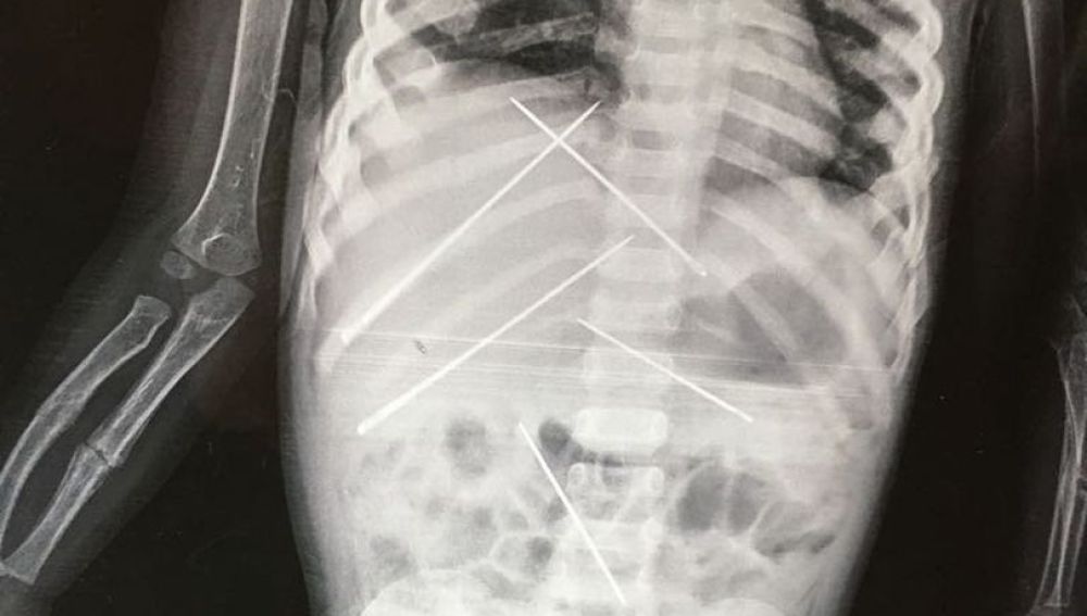 Agujas dentro del cuerpo de la niña