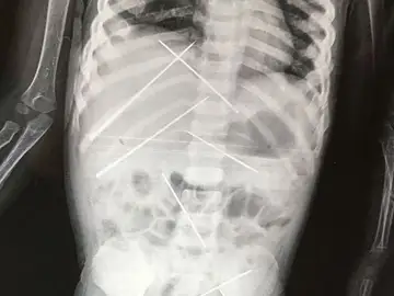 Agujas dentro del cuerpo de la niña Agujas dentro del cuerpo de la niña