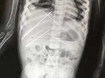 Agujas dentro del cuerpo de la niña Agujas dentro del cuerpo de la niña