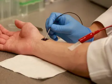 Nanochip en un paciente Nanochip en un paciente