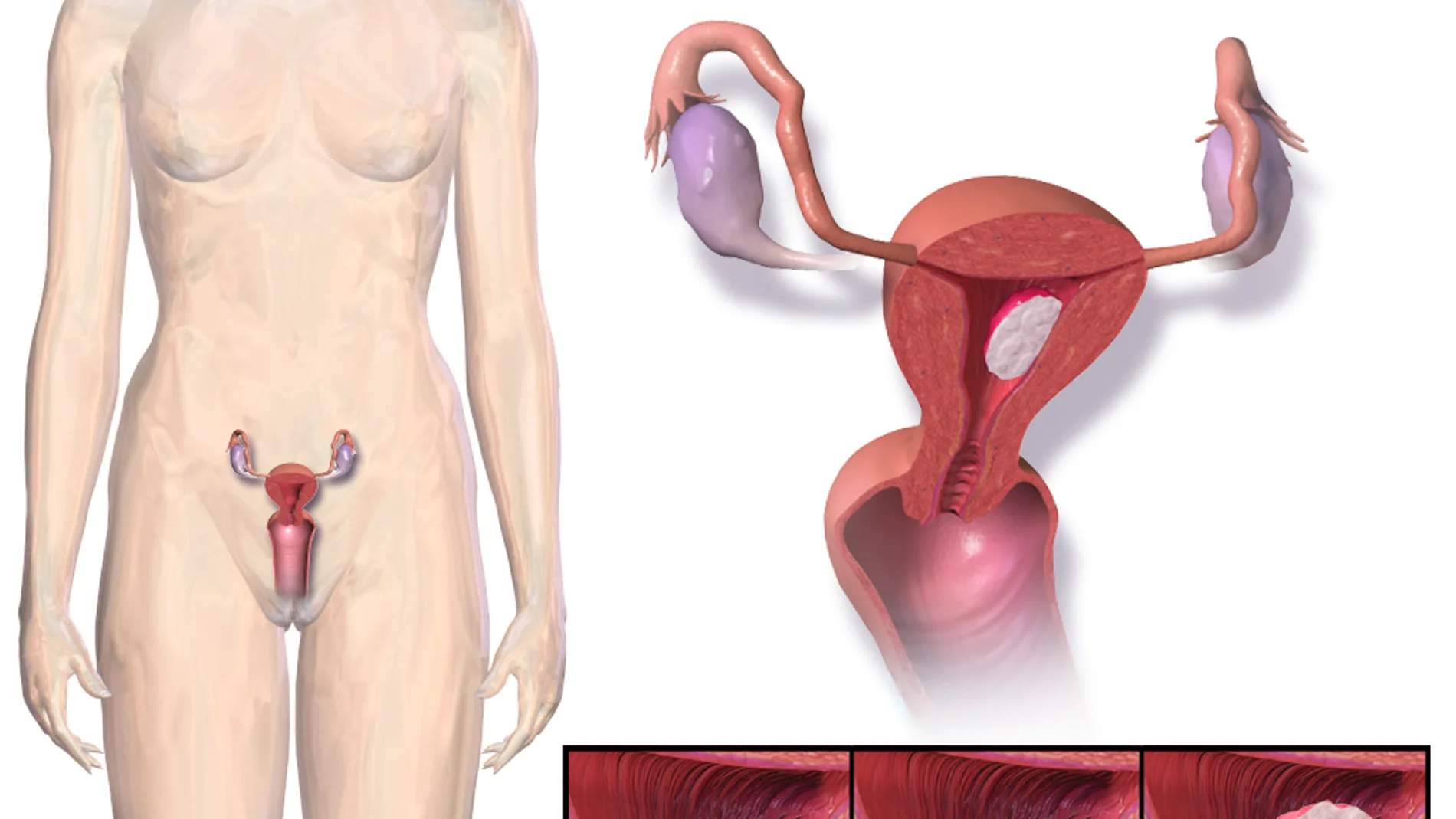 Cáncer de endometrio Cáncer de endometrio