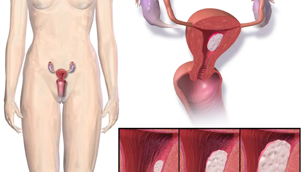 Cáncer de endometrio El cáncer de endometrio es más probable en mujeres con altos niveles de cadmio