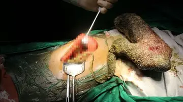 Cirujanos retiran bola de pelo a la paciente Cirujanos retiran bola de pelo a la paciente