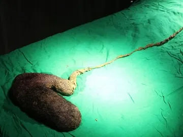 Bola de pelo extraída a la paciente Bola de pelo extraída a la paciente