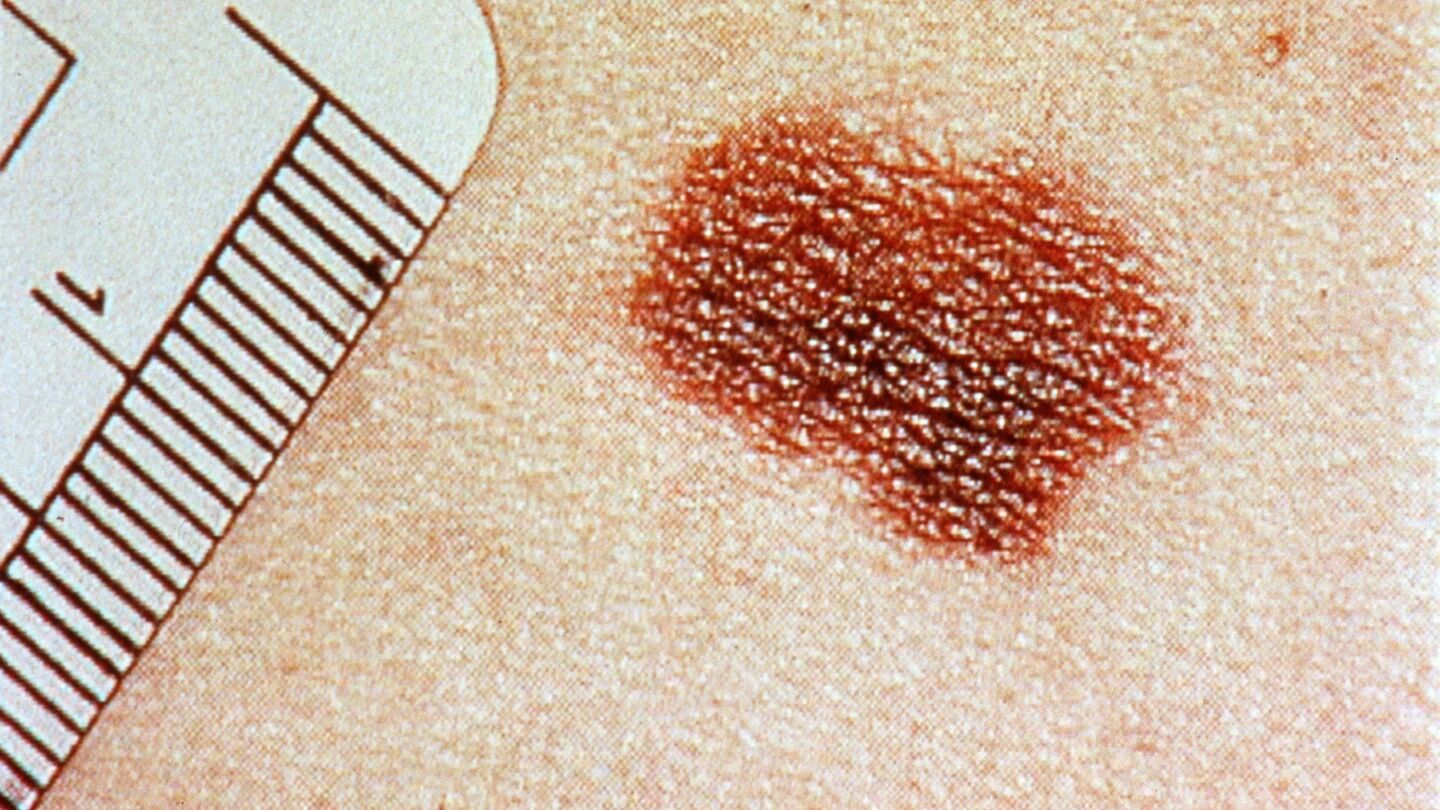 Melanoma